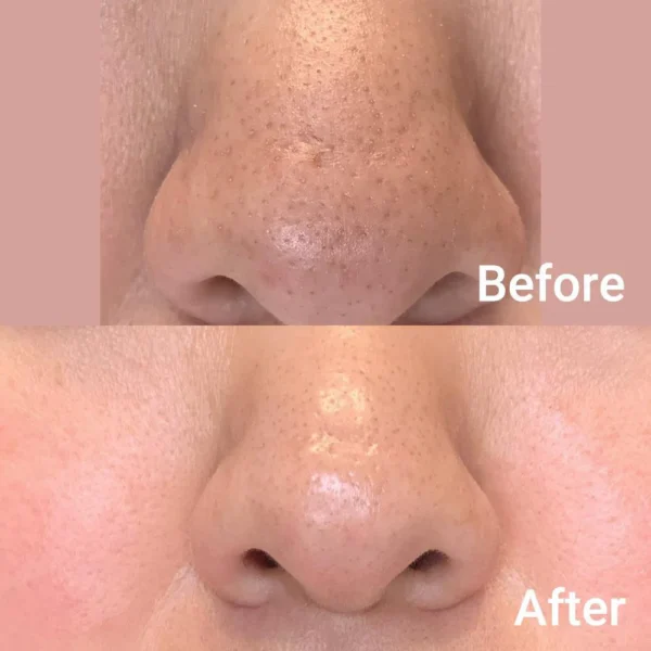 Medicube Zero Pore Pad - Imagen 4